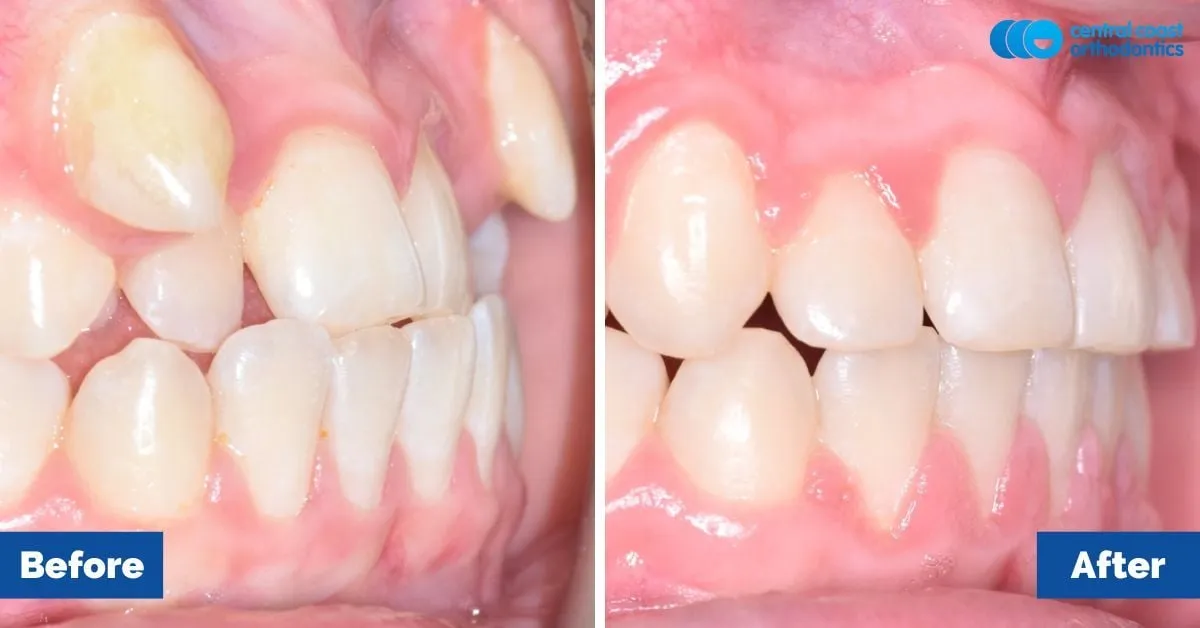 Before and after comparison, side view of the upper and lower teeth
