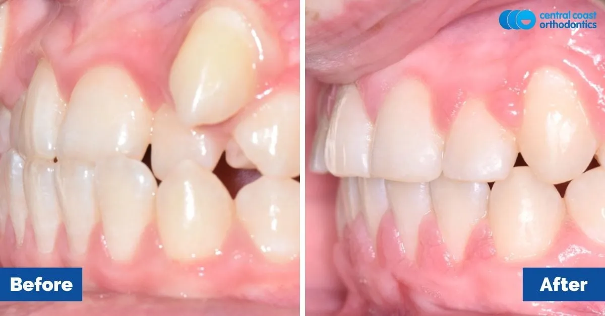 Before and after comparison, side view of the upper and lower teeth