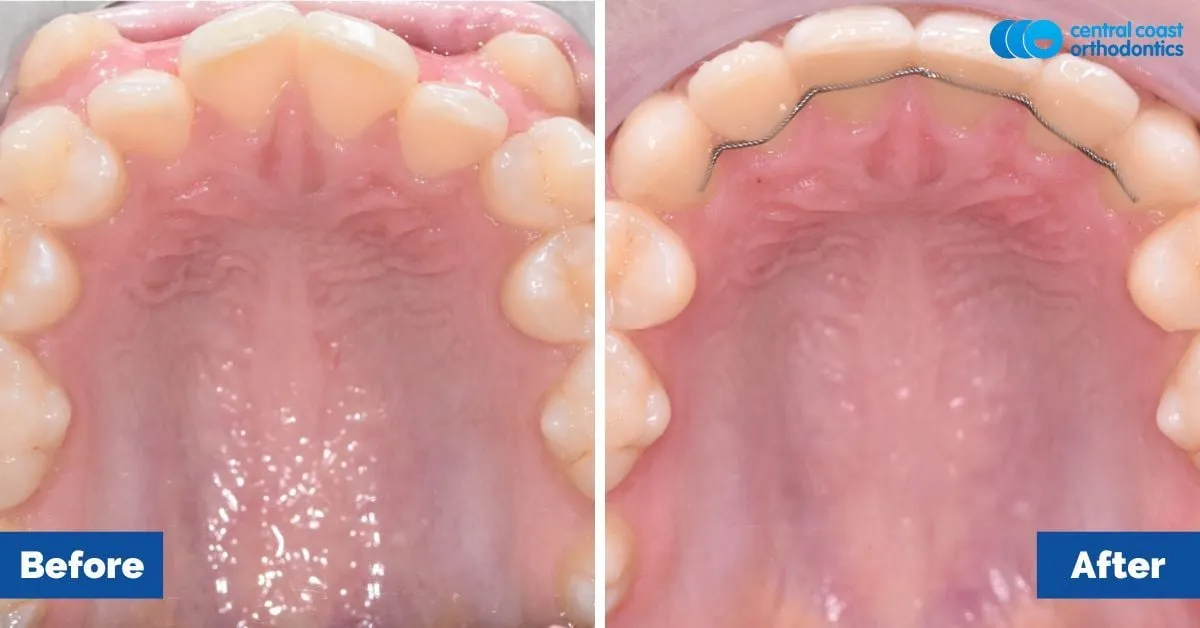 Before and after comparison, upper teeth viewed from below