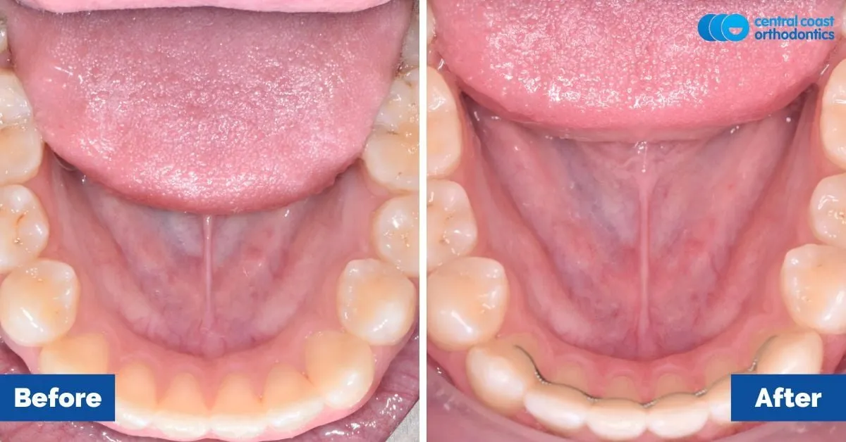 Before and after comparison, lower teeth viewed from above