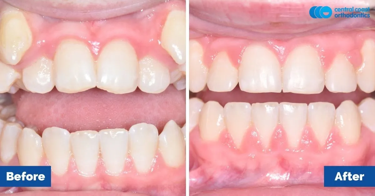 Before and after comparison, front view of the upper and lower teeth