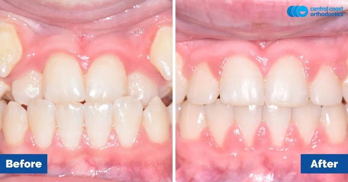 Before and after comparison, front view of the upper and lower teeth