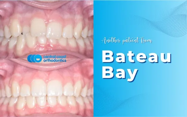 Before and after photographs of a Central Coast Orthodontics patient's teeth, labelled Bateau Bay