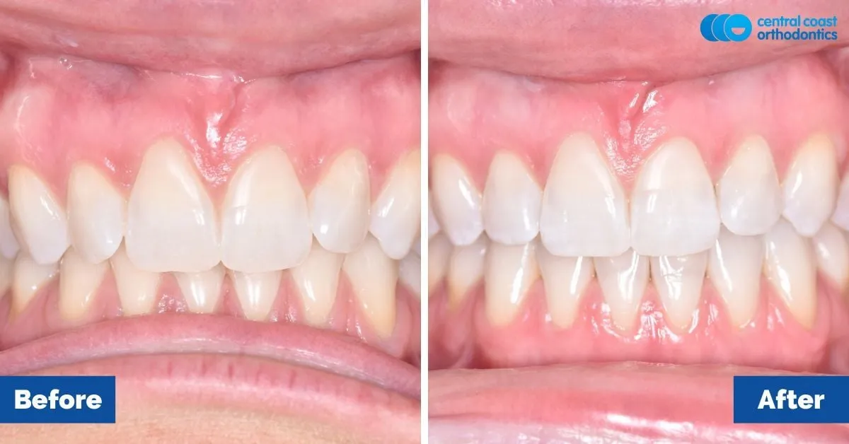 Before and after comparison, front view of the upper and lower teeth
