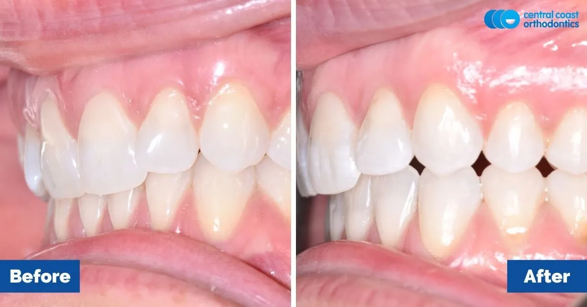 Before and after comparison, front view of the upper and lower teeth