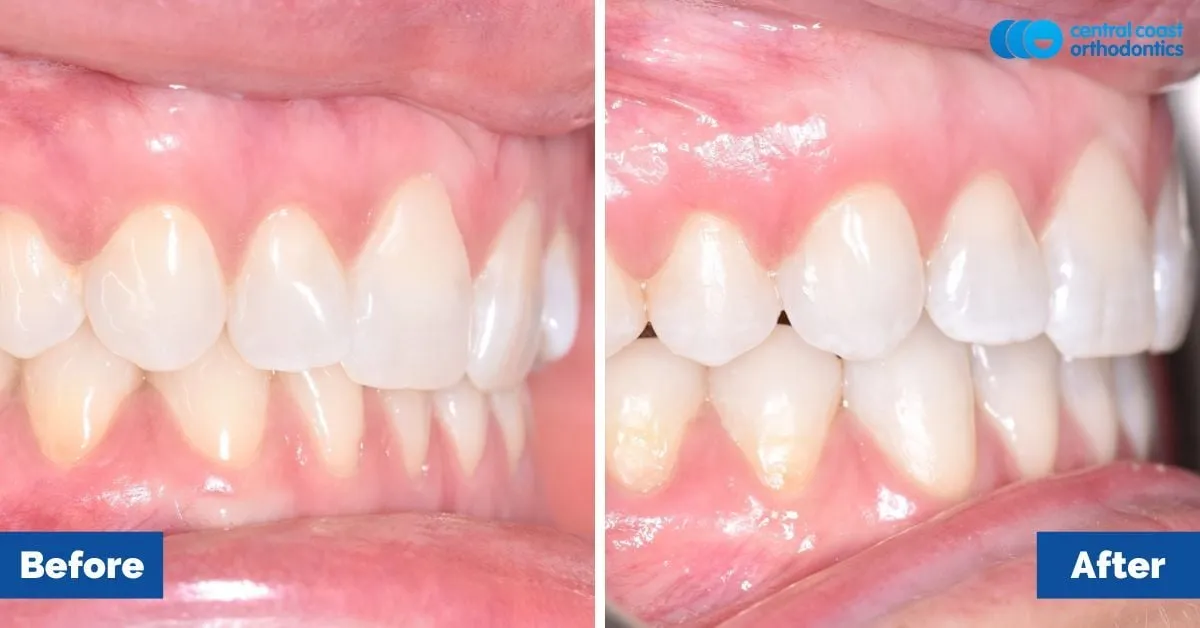 Before and after comparison, front view of the upper and lower teeth