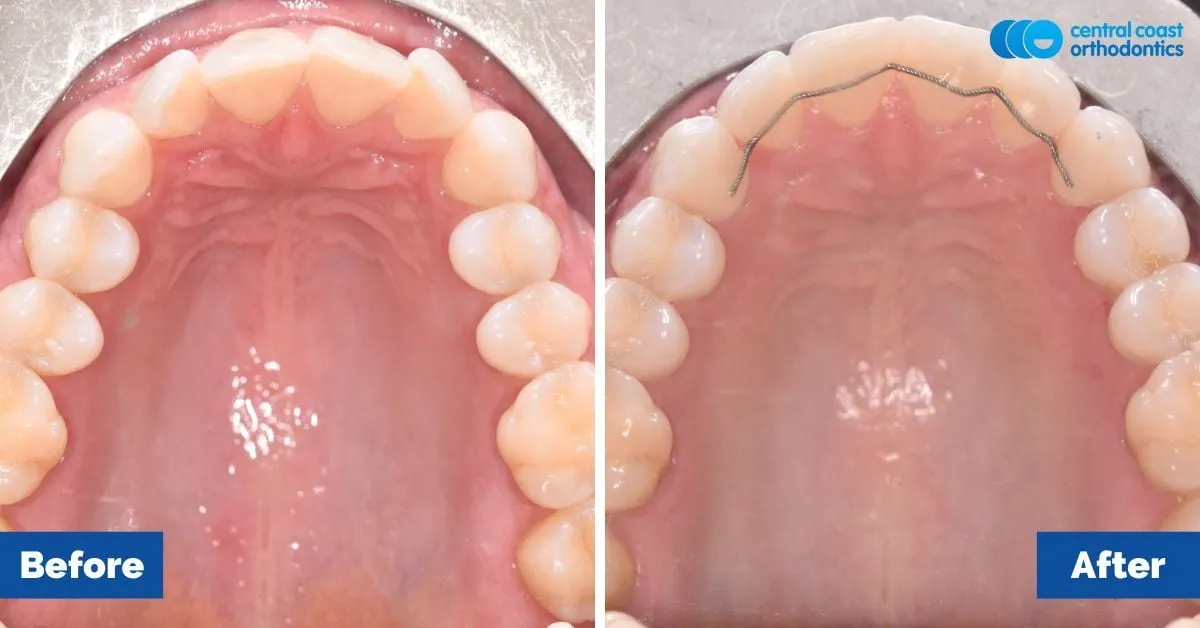 Before and after comparison, upper teeth viewed from below