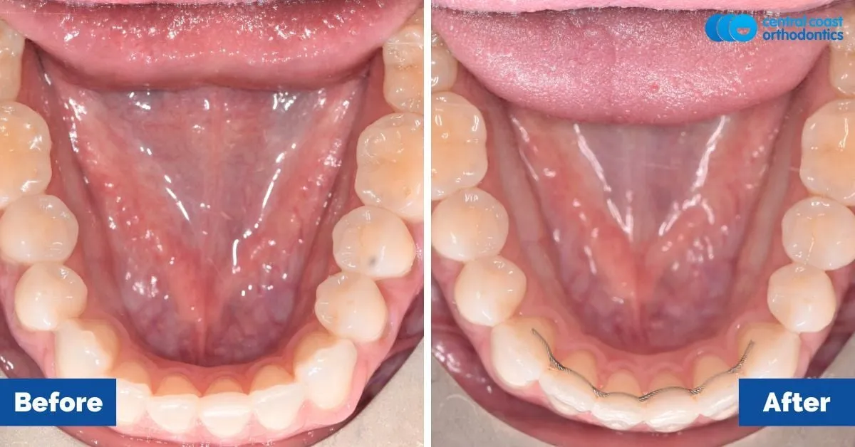 Before and after comparison, lower teeth viewed from above