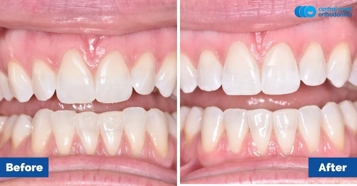 Before and after comparison, front view of the upper and lower teeth