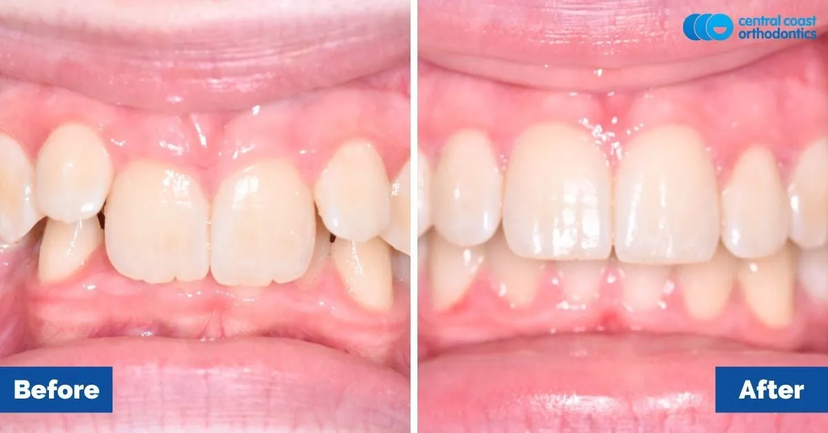 Before and after comparison, front view of the upper and lower teeth