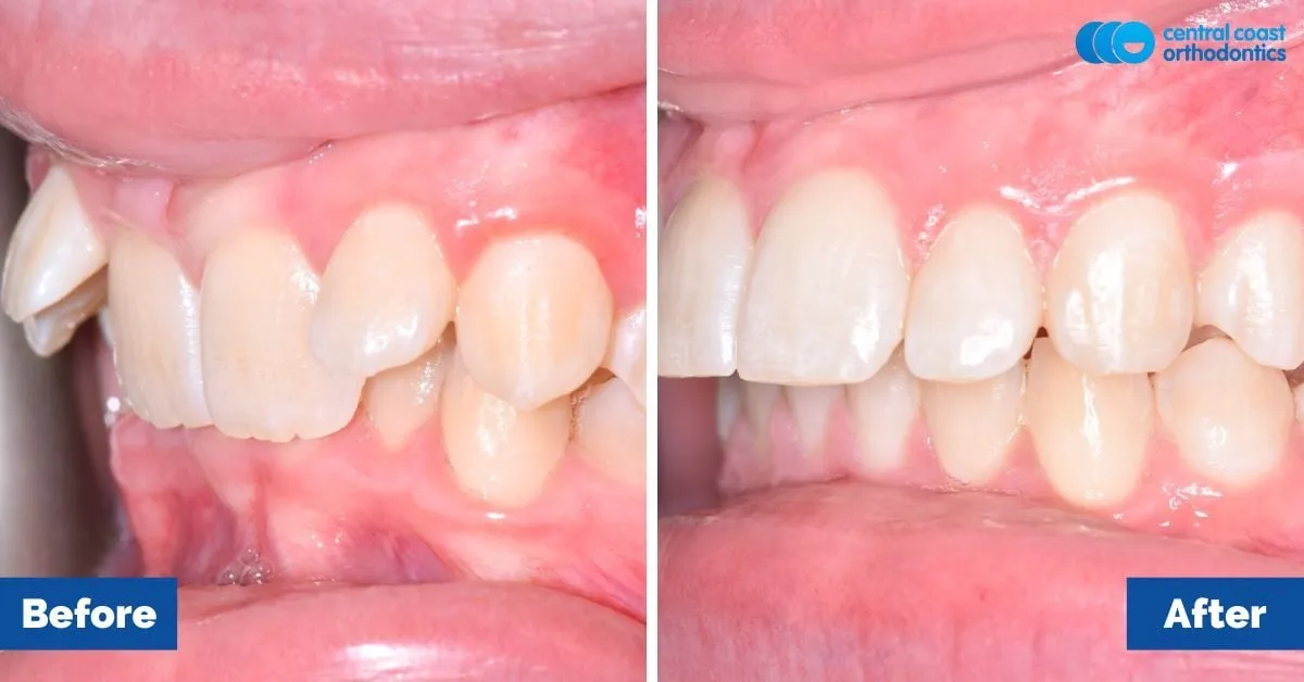 Before and after comparison, side view of the upper and lower teeth