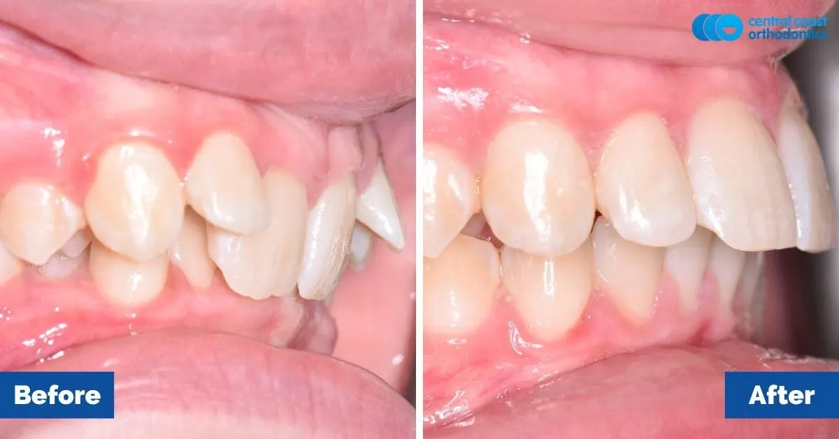 Before and after comparison, side view of the upper and lower teeth