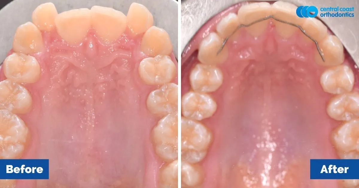 Before and after comparison, upper teeth viewed from below