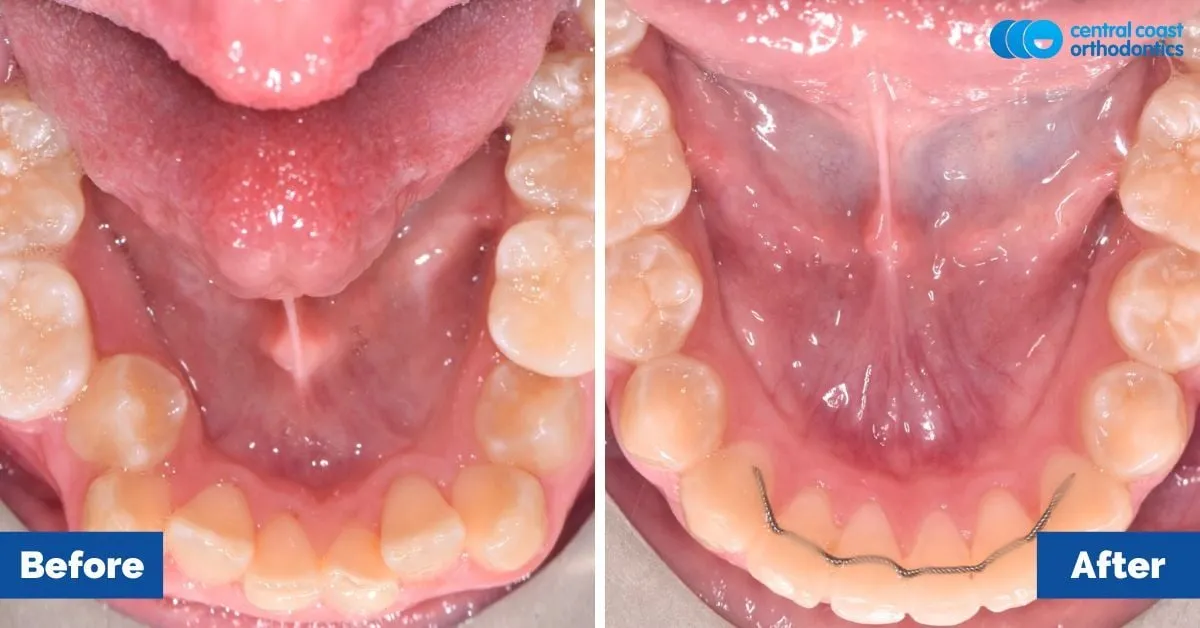 Before and after comparison, lower teeth viewed from above
