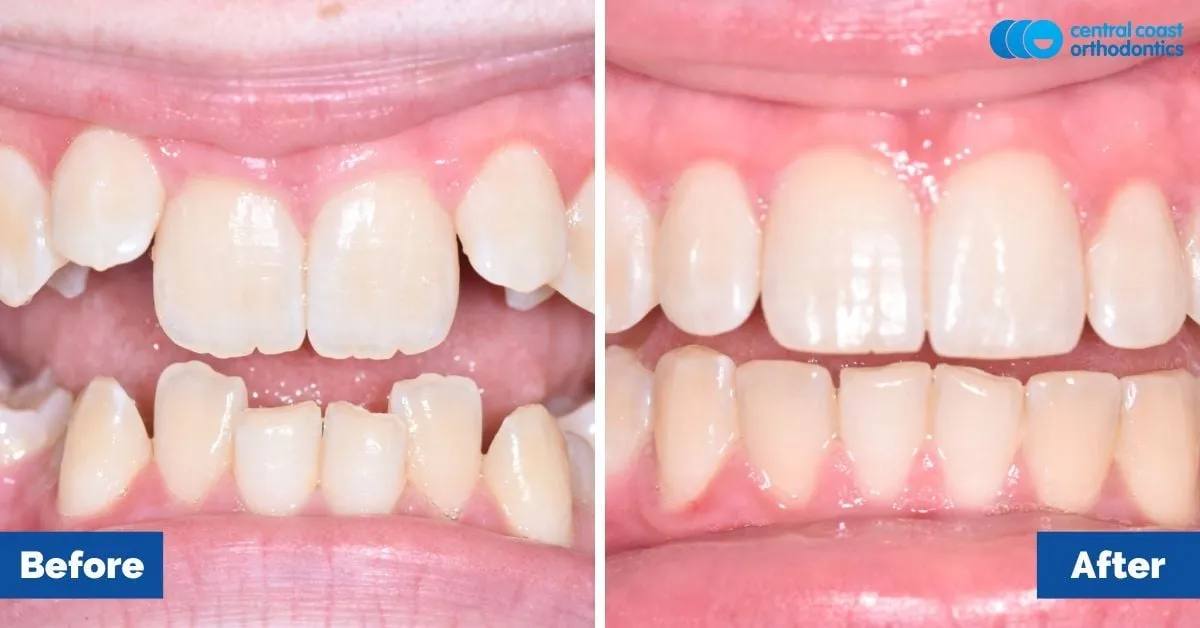 Before and after comparison, front view of the upper and lower teeth