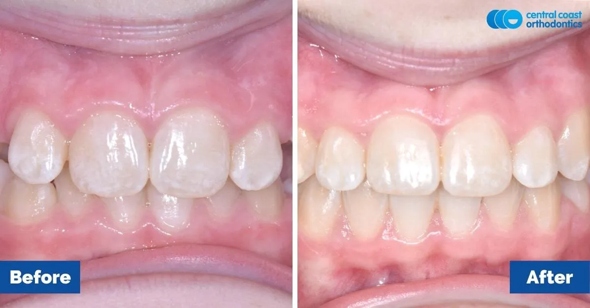 Before and after comparison, front view of the upper and lower teeth