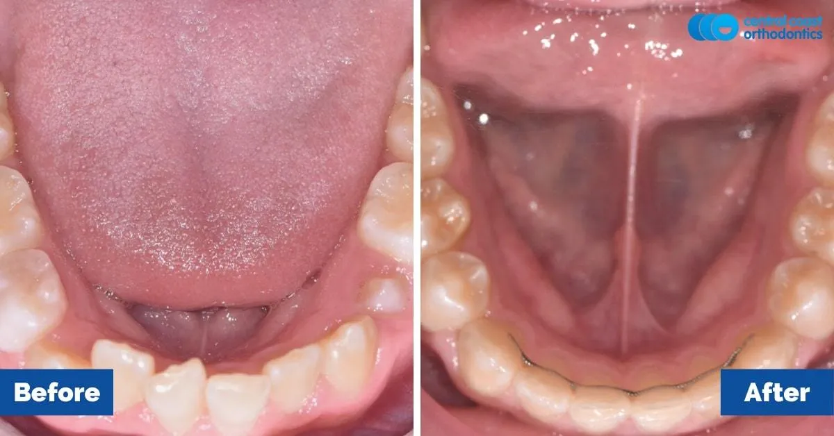 Before and after comparison, lower teeth viewed from above