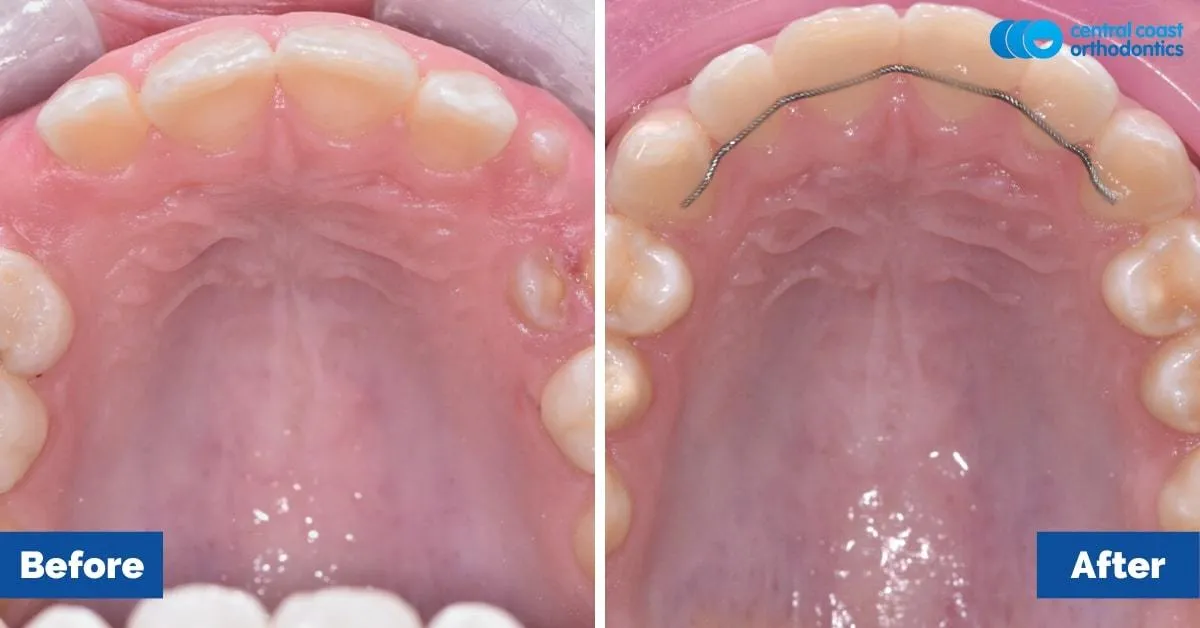 Before and after comparison, upper teeth viewed from below
