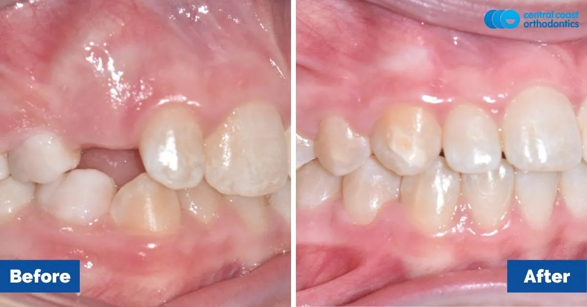 Before and after comparison, side view of the upper and lower teeth