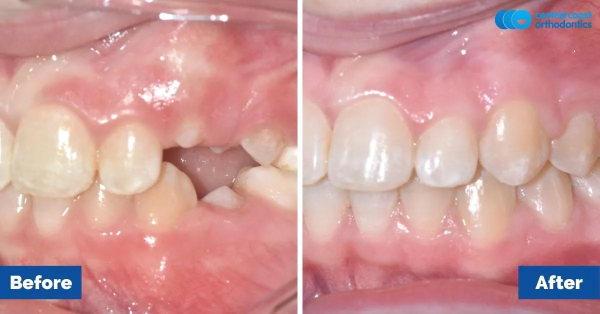 Before and after comparison, side view of the upper and lower teeth