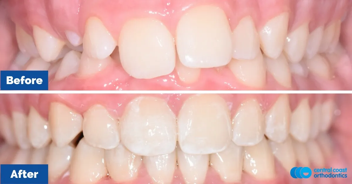 Before and after comparison, front view of the upper and lower teeth