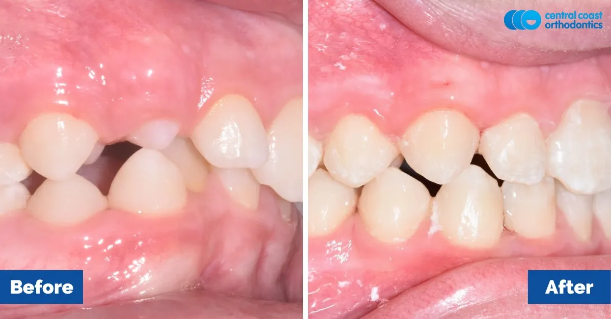 Before and after comparison, side view of the upper and lower teeth