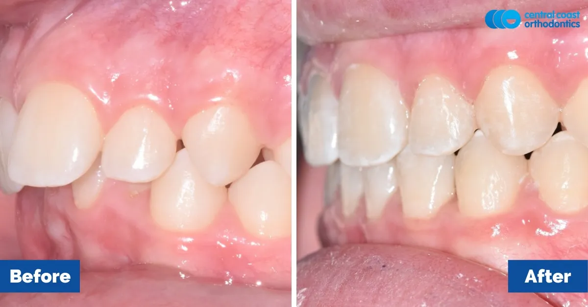 Before and after comparison, side view of the upper and lower teeth