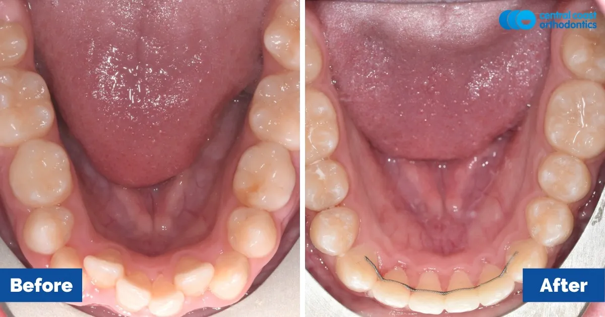 Before and after comparison, lower teeth viewed from above