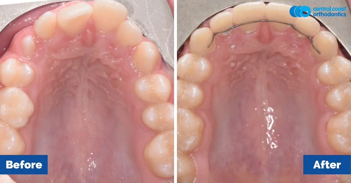 Before and after comparison, upper teeth viewed from below