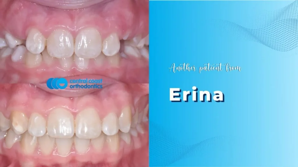 Before and after photographs of a Central Coast Orthodontics patient's teeth, labelled Erina