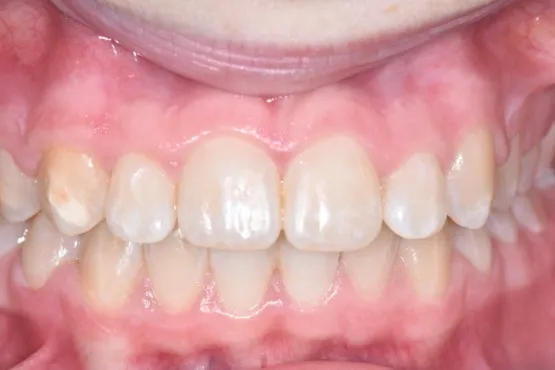 Patient of Erinau2019s Braces Makeover