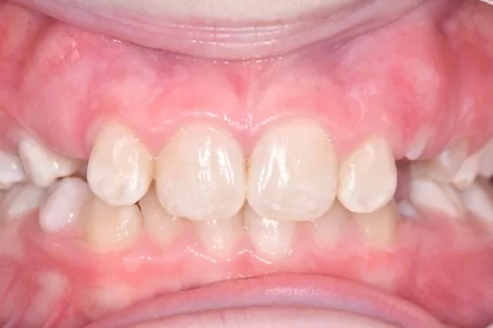 Patient of Erinau2019s Braces Makeover
