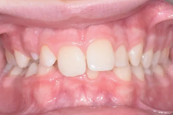 Patient of Erinau2019s Invisalign Makeover