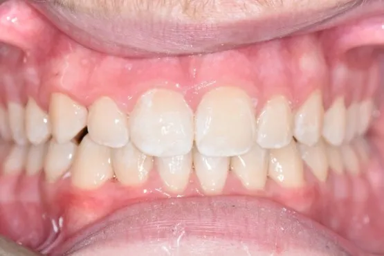 Patient of Erinau2019s Invisalign Makeover