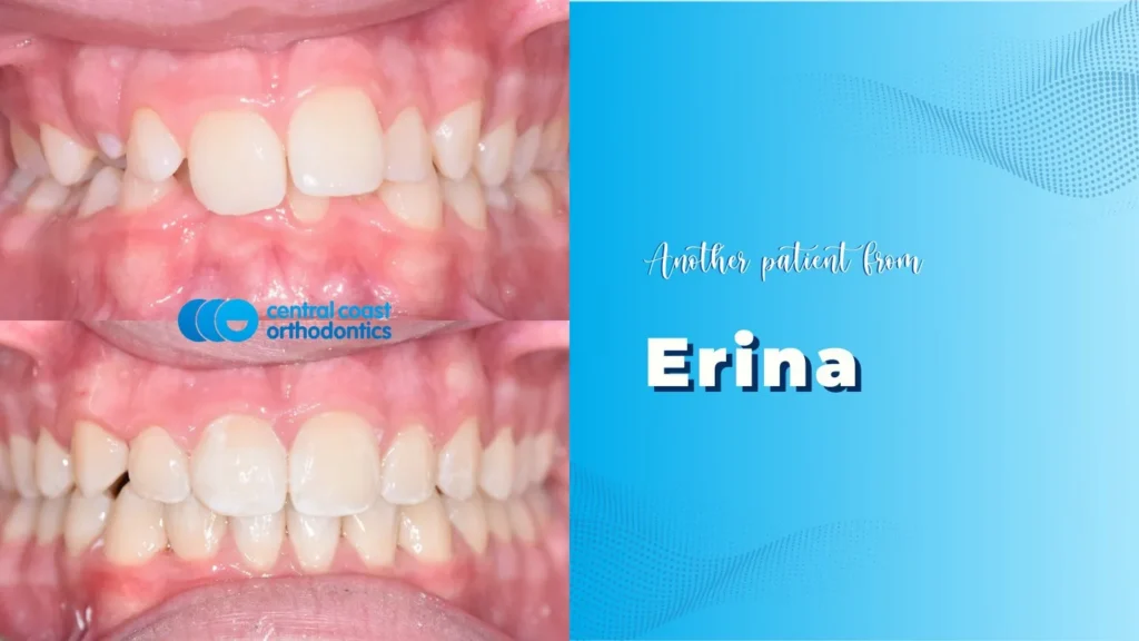 Before and after photographs of a Central Coast Orthodontics patient's teeth, labelled Erina