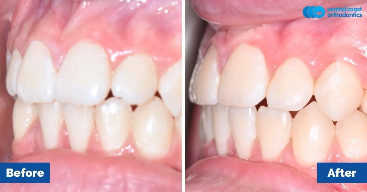 Before and after comparison, front view of the upper and lower teeth