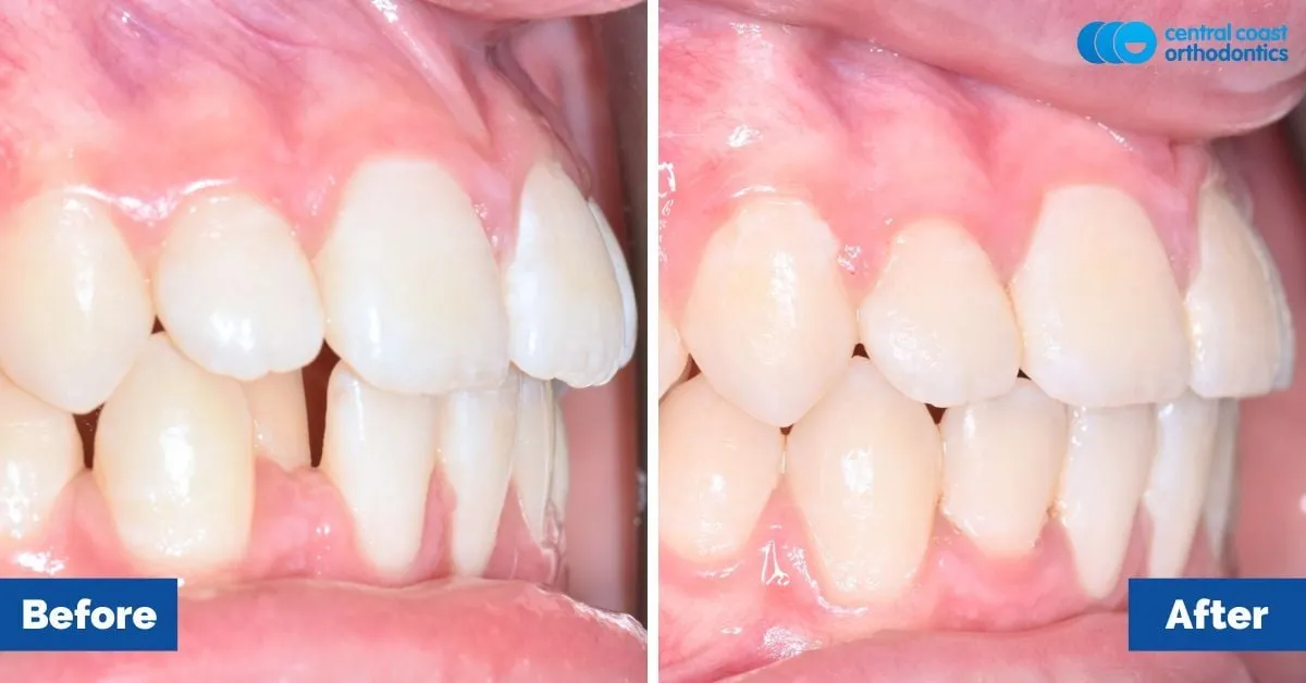 Before and after comparison, side view of the upper and lower teeth