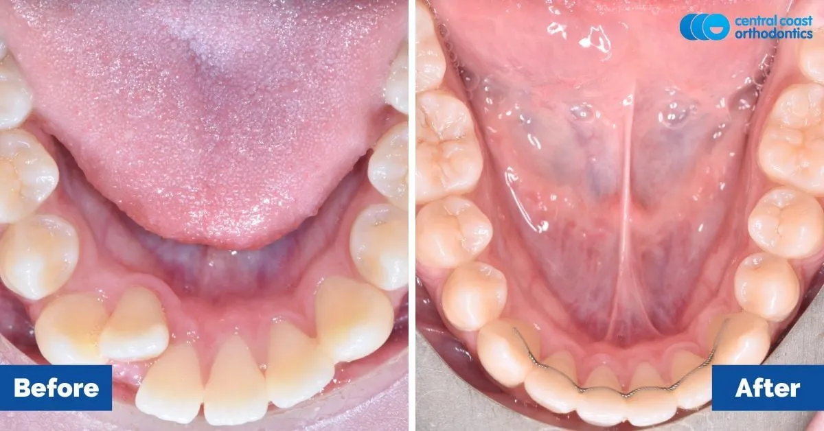 Before and after comparison, lower teeth viewed from above