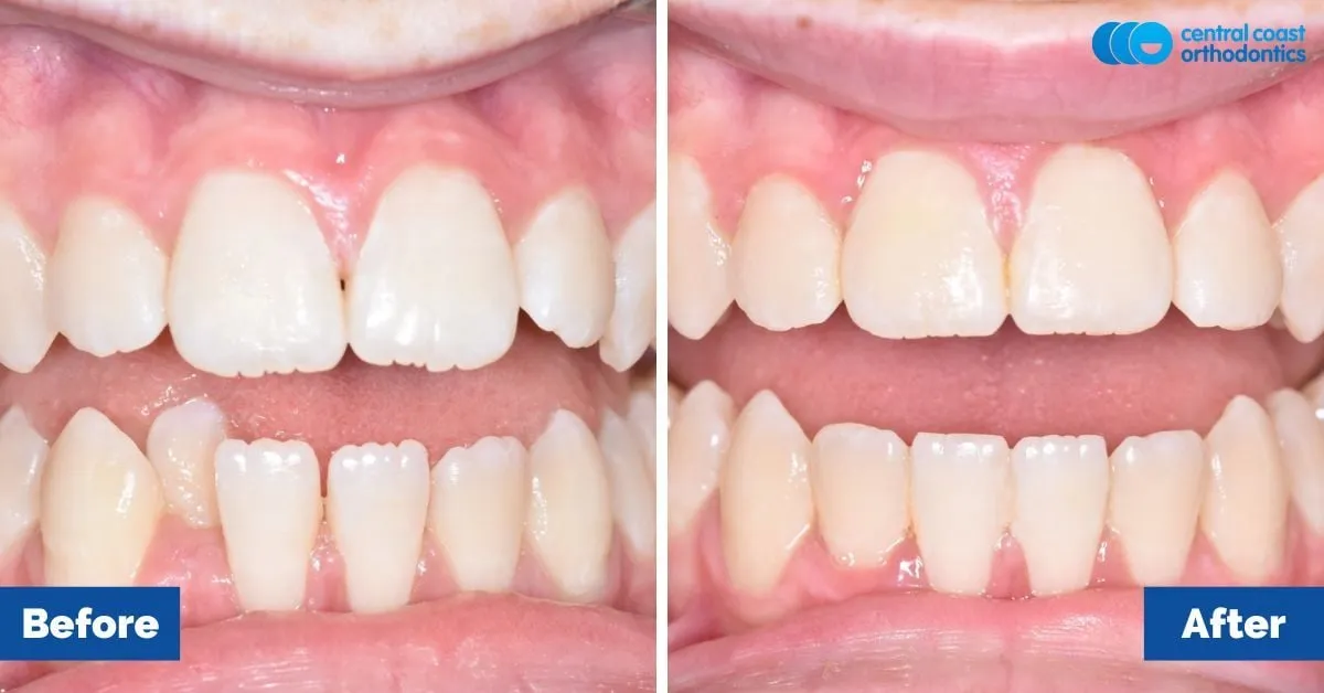 Before and after comparison, front view of the upper and lower teeth