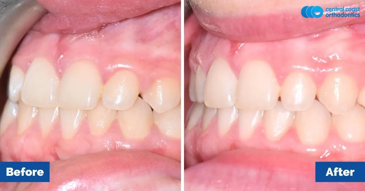 Before and after comparison, front view of the upper and lower teeth