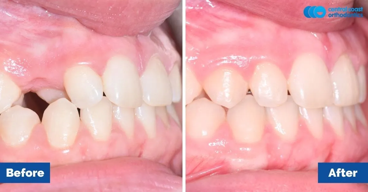 Before and after comparison, side view of the upper and lower teeth