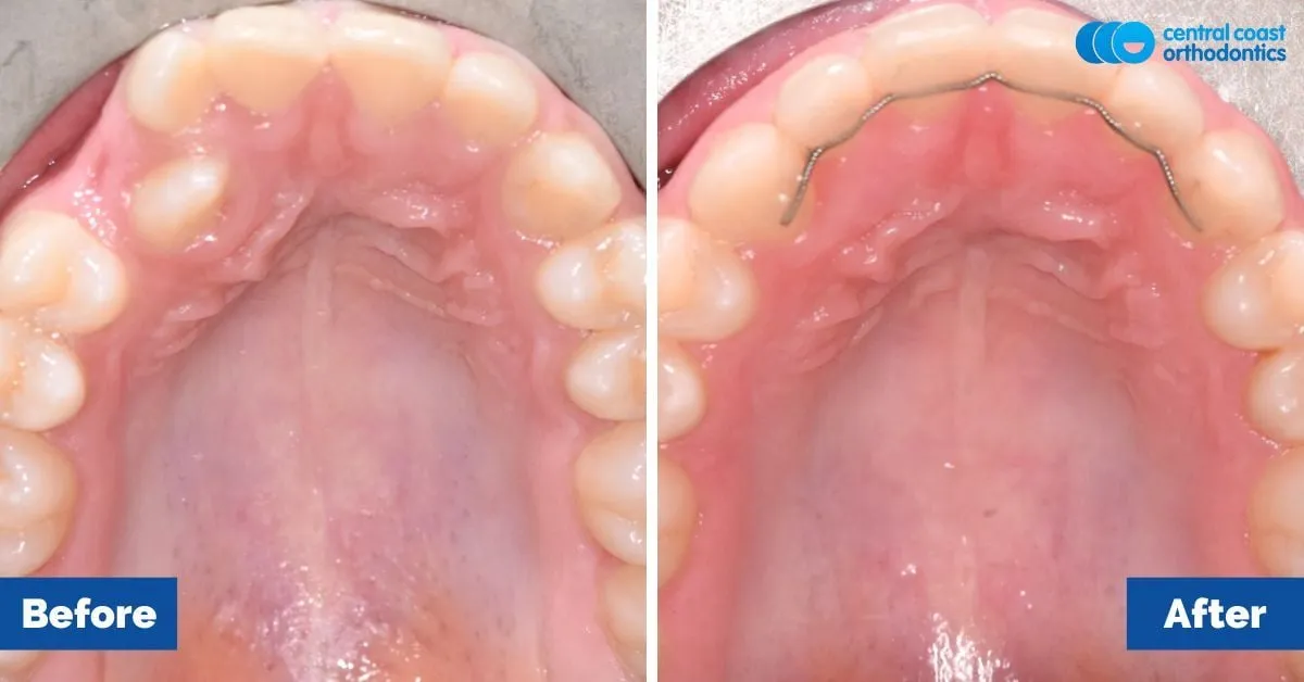 Before and after comparison, upper teeth viewed from below