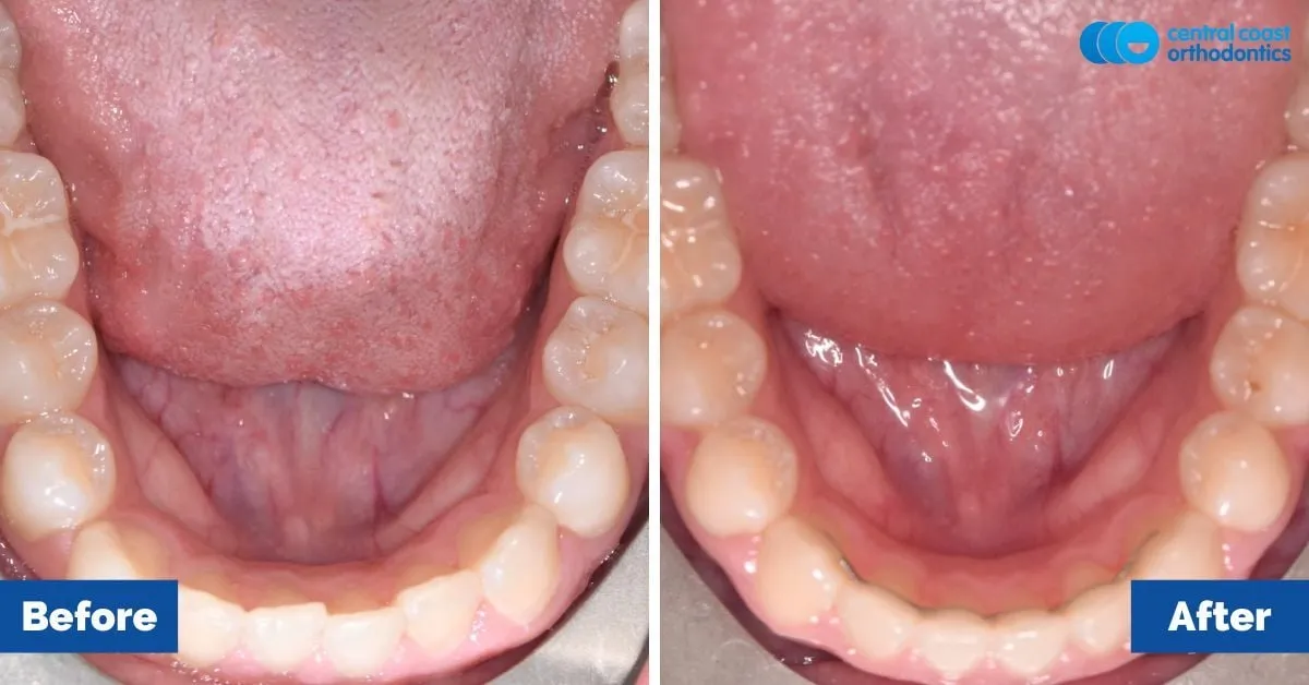 Before and after comparison, lower teeth viewed from above
