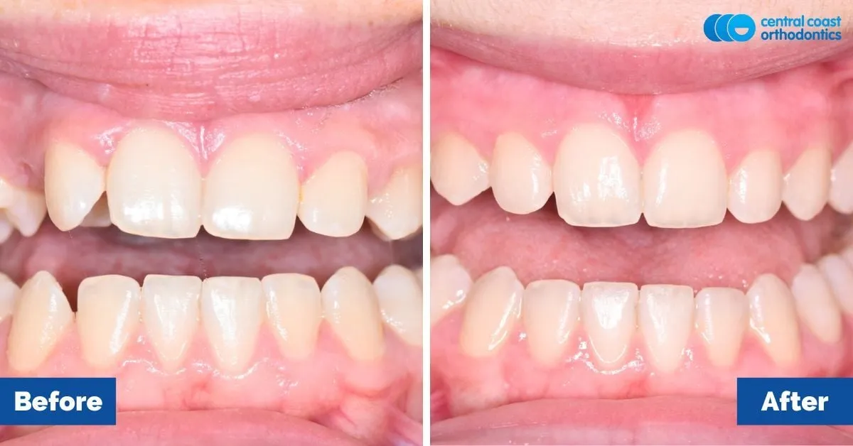 Before and after comparison, front view of the upper and lower teeth