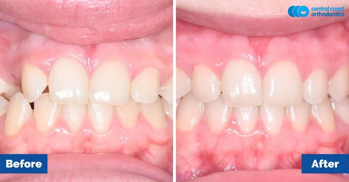 Before and after comparison, front view of the upper and lower teeth