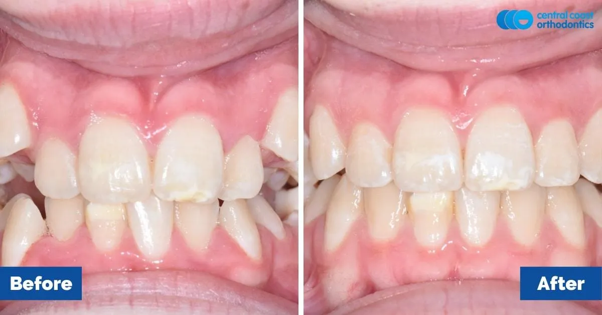 Before and after comparison, front view of the upper and lower teeth