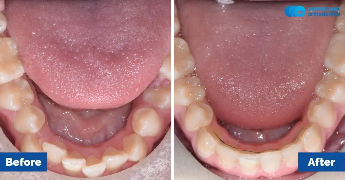 Before and after comparison, lower teeth viewed from above