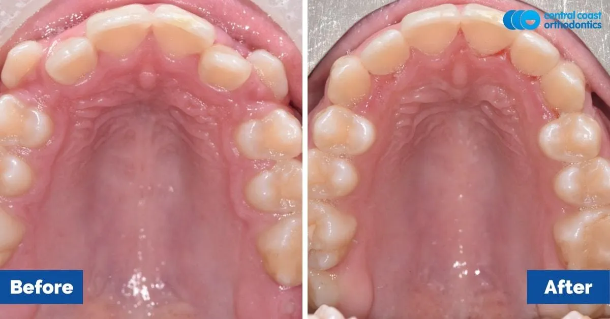 Before and after comparison, upper teeth viewed from below