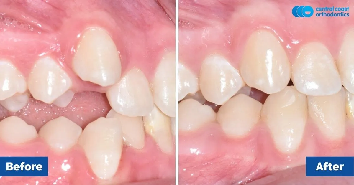 Before and after comparison, side view of the upper and lower teeth