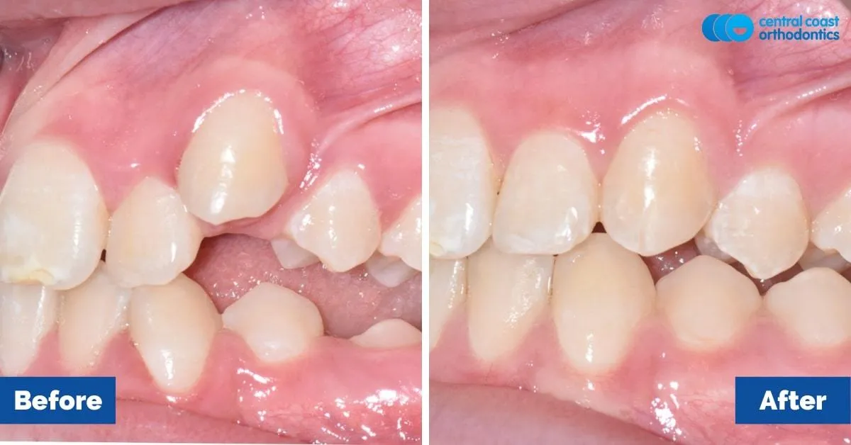 Before and after comparison, side view of the upper and lower teeth